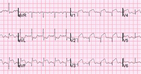 Dr Smiths Ecg Blog 50 Something With Stemi And Hypotension What Is