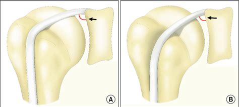 Biceps Tendon Anatomy Shoulder Biceps Tendinitis Brisbane Knee And