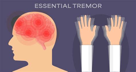 Essential Tremor Treatment Symptoms And Causes What Is Essential Tremor Mnc