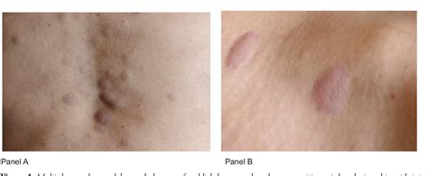 Figure From Leukaemia Cutis In A Patient With Chronic Myeloid