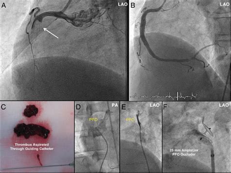 Myocardial Infarction Mi By Paradoxical Embolism Through A Patent