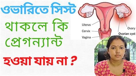 How Ovarian Cyst Can Impact Your Fertility I ওভারি সিস্ট সন্তানধারণ