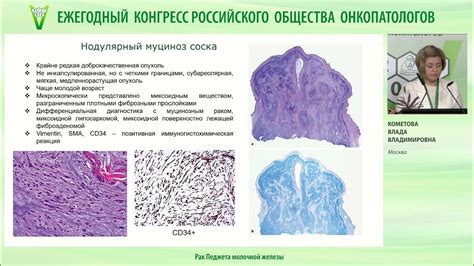 Рак Педжета молочной железы - YouTube