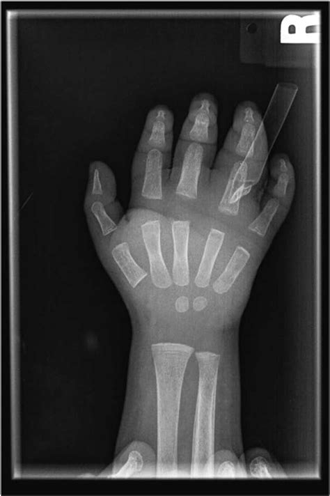 Initial Posterior Anterior Radiograph Of The Hand Following Incision