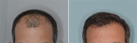 Hair Transplants For Men Photos Miami Fl Patient126399