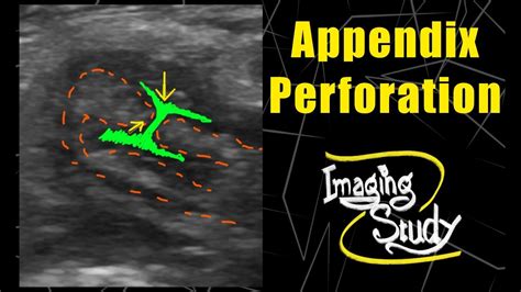 Perforated Vermiform Appendix Ultrasound Case 110 Youtube