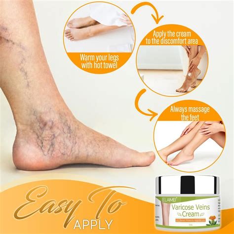 Heal Your Varicose Veins Artofit