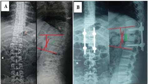 A Pre Operative Radiograph Of 30 Years Old Male Patient D12 And B