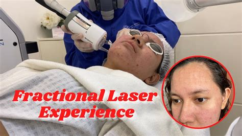 My Fractional Laser Experience Mona Ria YouTube