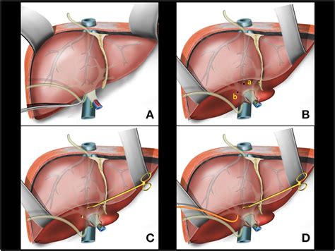 A Hanging Liver Maneuver Naso Gastric Tube Passage In The