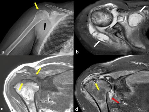 X Ray Of The Right Shoulder Shows Enlarged Joint Space Calcifications Download Scientific