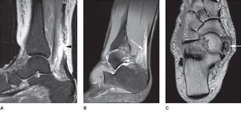 Ankle MRI | Radiology Key