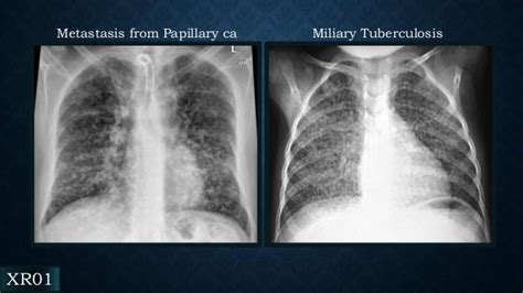 Radiology of Tuberculosis