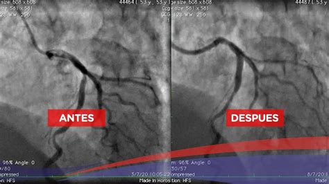 Angioplastia coronaria a bifurcación en arteria descendente anterior y