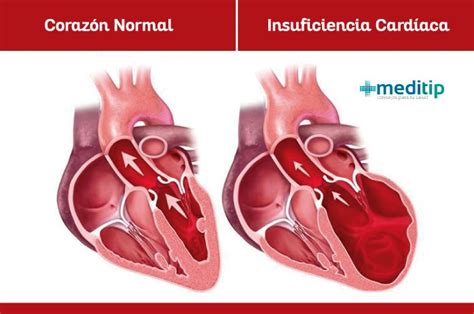 Insuficiencia cardíaca Meditip