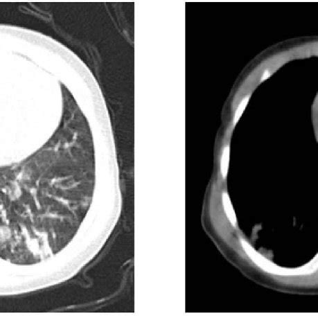 Ct Imaging Findings Of Mild Cases Notes Lung Markings Are Increased