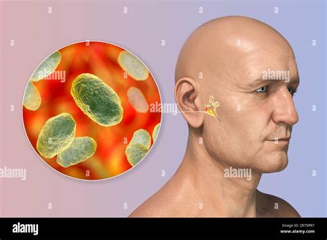 Otitis media infección del oído causada por la bacteria Haemophilus