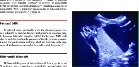 Simple Fnoc With Daughter Cyst Download Scientific Diagram