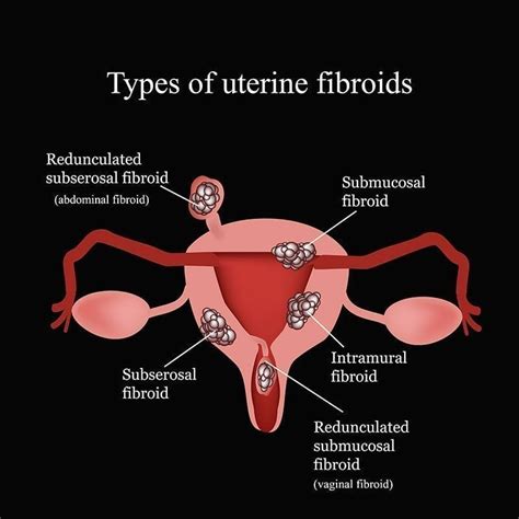 Uterine Fibroids And Their Role On Infertility Fertility Tips