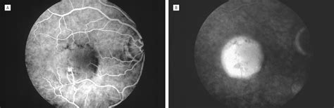 Retinal Angiomatous Proliferation Dermatology Jama Ophthalmology