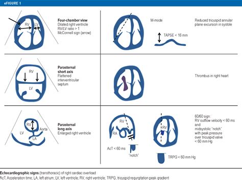 Acute Pulmonary Embolism Its Diagnosis And Treatment From A