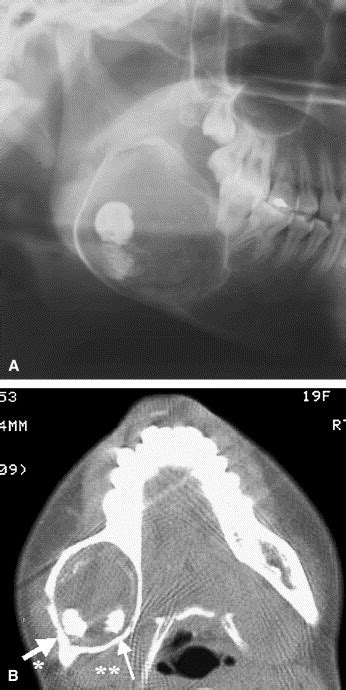 Calcifying Odontogenic Cyst Radiologic Findings In 11 Cases Oral