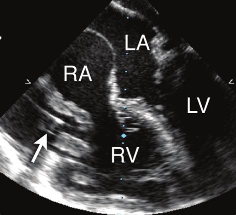 Transesophageal Echocardiographic Midesophageal Four Chamber View Ra Download Scientific