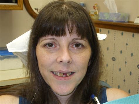 denture 19 before - Portland Dentures & Dental Implants