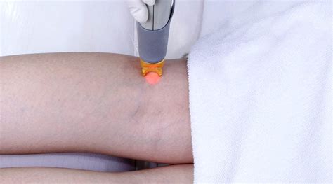 Laser Treatment For Varicose Veins And Spider Veins Premier Clinic