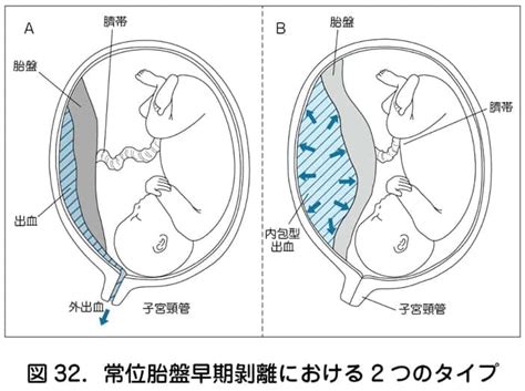 胎盤の基礎｜完成時期や役割・妊娠中の胎盤トラブルと予防法を解説【妊娠初期の方へ】