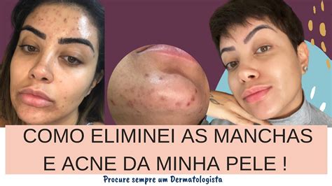 COMO ELIMINEI AS MANCHAS E ACNE DA MINHA PELE YouTube