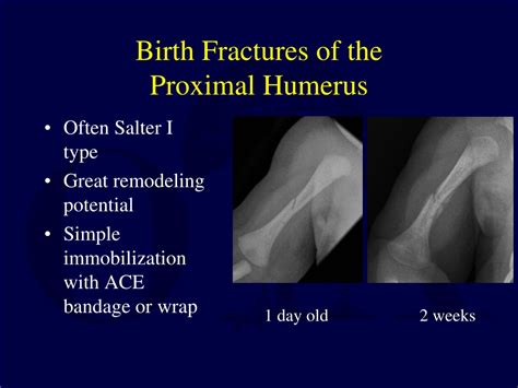 PPT Fractures And Dislocations About The Shoulder In The Pediatric