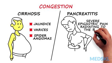 Splenomegaly Remember The Primary Causes With Cip Youtube