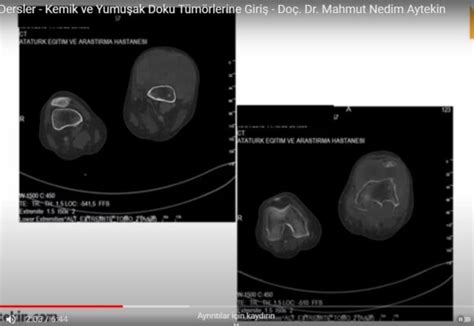 Akademik Dersler Kemik ve Yumuşak Doku Tümörlerine Giriş TV Programları