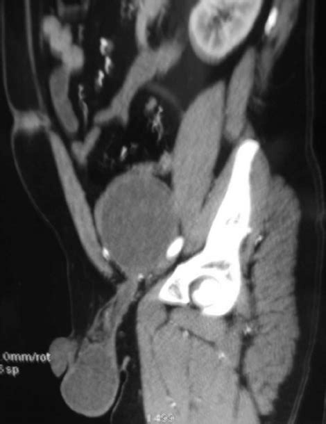 Ct Showed A Cystic Mass In The Region Of The Superficial Ring In Close