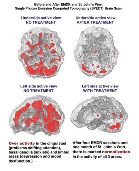 Gulin Aydin, MSW, RSW : Brain Scan (Before and After EMDR)