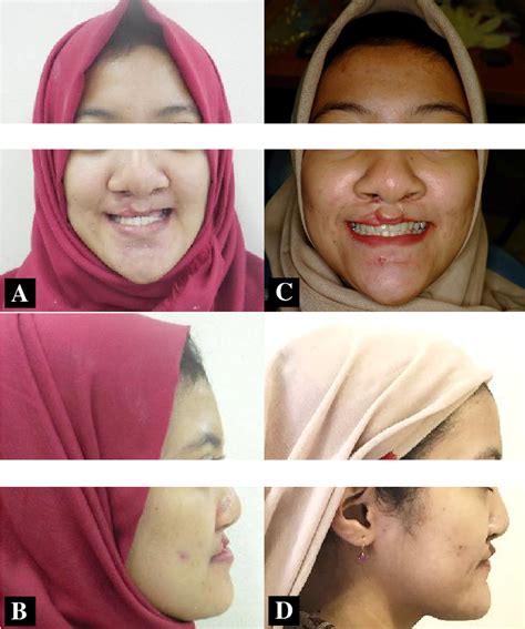 Pre Treatment A B And Post Treatment C D Extraoral Photographs