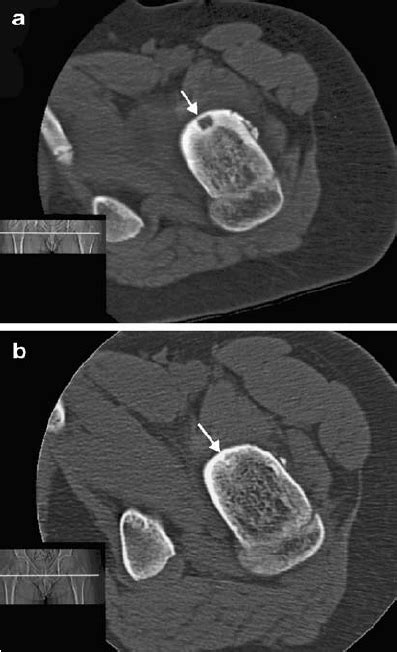 Axial Ct Image Of A Nidus In The Left Hip Region Arrow In A Download Scientific Diagram