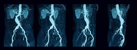 Pulmonary angiography | PHA