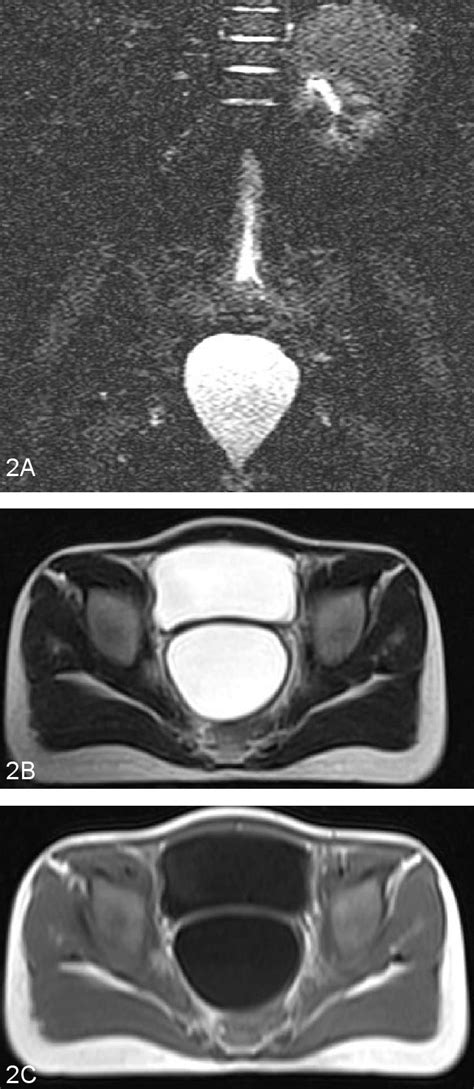 Mullerian Cyst Female