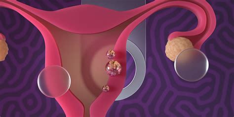 Understanding Endometrial Cancer Causes Symptoms And Treatments Dr