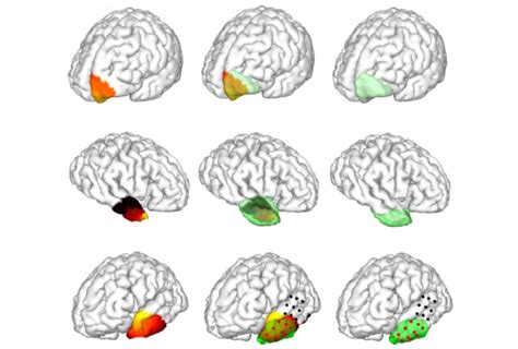 New Noninvasive Approach Maps Seizure Generating Brain Areas CURE