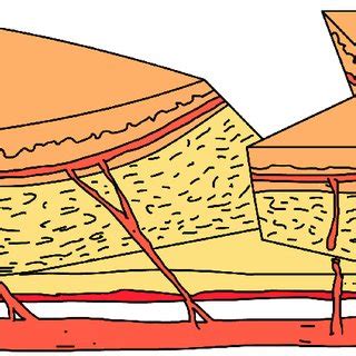 Schematic diagram of the V-Y advancement flap. The subcutaneous flap ...