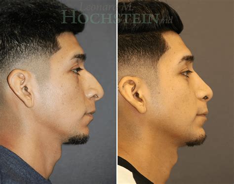 Rhinoplasty Surgery Nose Surgery Miami Fl Dr Leonard Hochstein