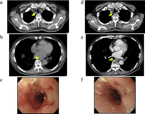 Image findings after chemotherapy and chemoradiotherapy. Computed ...