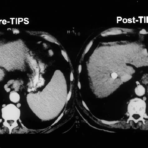 Contrast Enhanced Abdominal Computed Tomography Ct Scans Before And Download Scientific