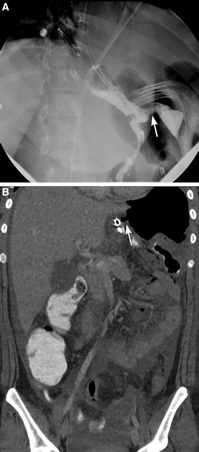 Complications after sleeve gastrectomies. Two separate patients who ...