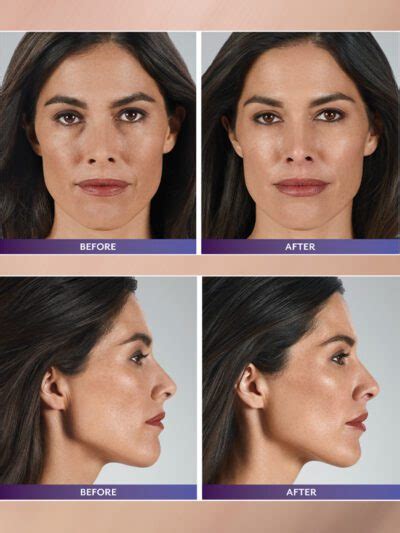 Dermal Fillers Renew Skin Care Center