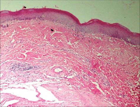 Oral Submucous Fibrosis Histopathology