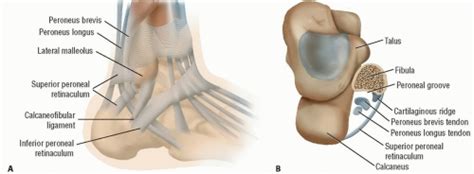 Repair of Dislocating Peroneal Tendons: Perspective 2 | Musculoskeletal Key